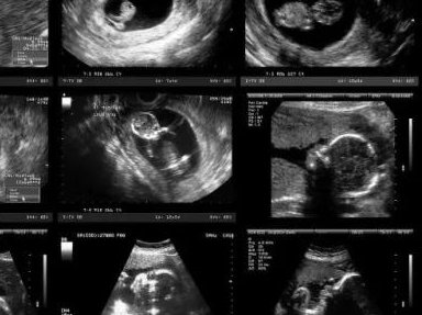 详细解读舟山市做长方案试管婴儿费用，长方案和短方案成功率有差别吗？